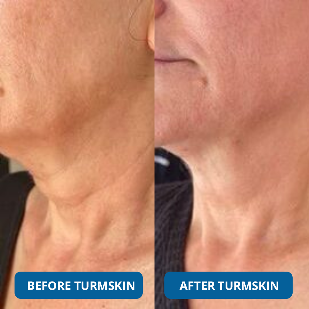 3% Hyaluronic Acid Ultra Hydrating Serum by TurmSkin