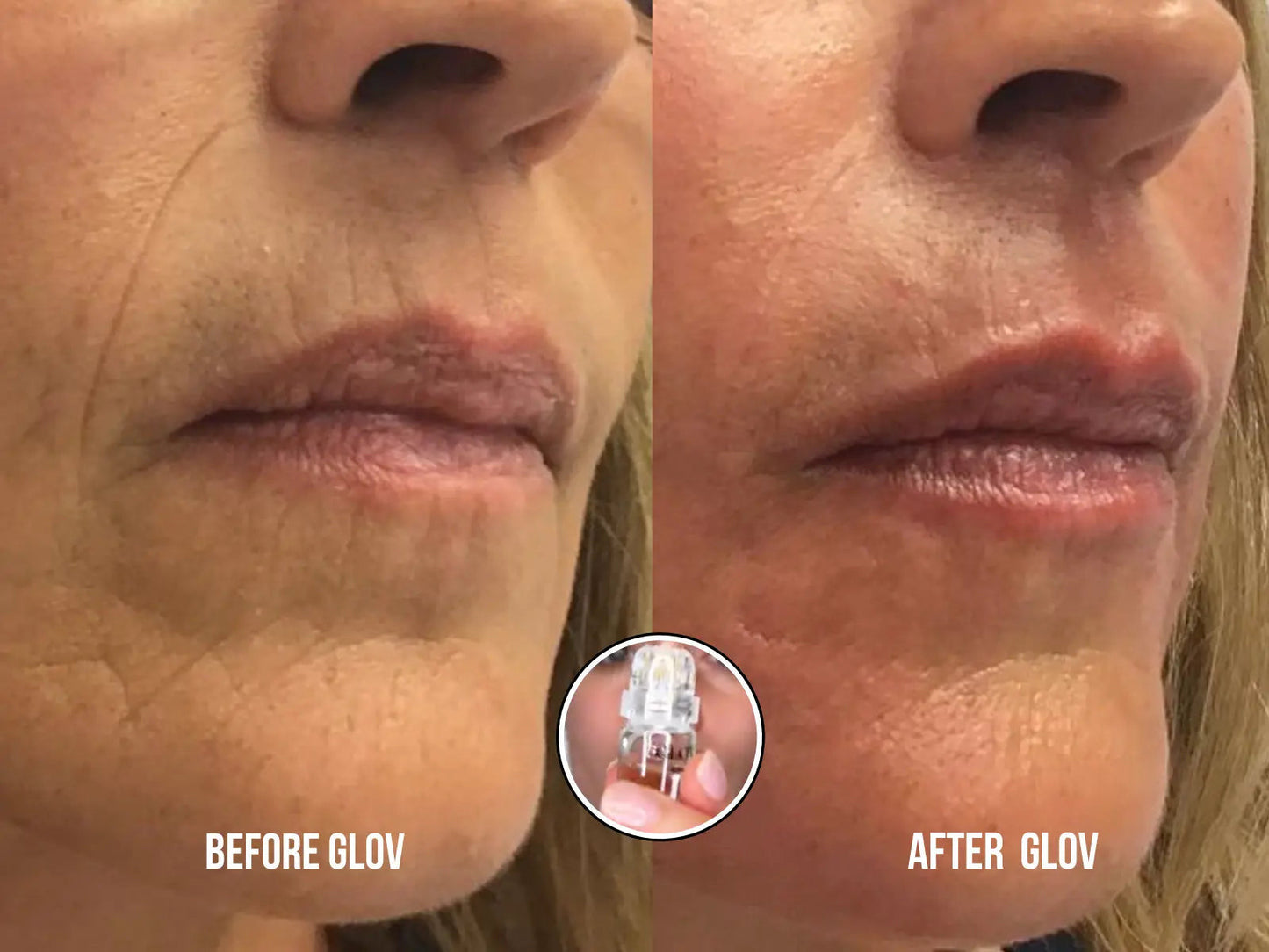 Glov Micro Infusion System